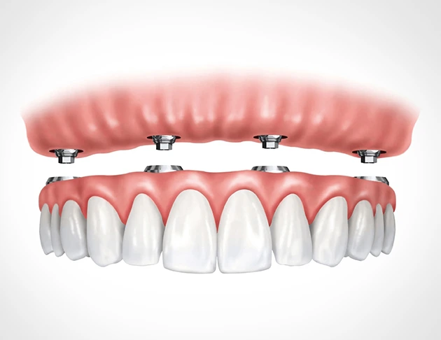 Implant-supported denture illustration showcasing a full arch of prosthetic teeth secured by dental implants, relevant to Warwick Dental's offerings for sedation dentistry and implant services.