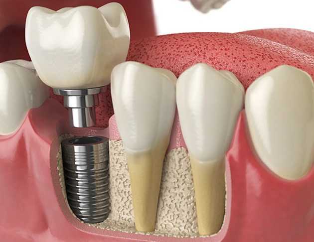 Dental implant illustration showing titanium post and crown placement in gum tissue, relevant to sedation dentistry and restorative dental care at Warwick Dental.
