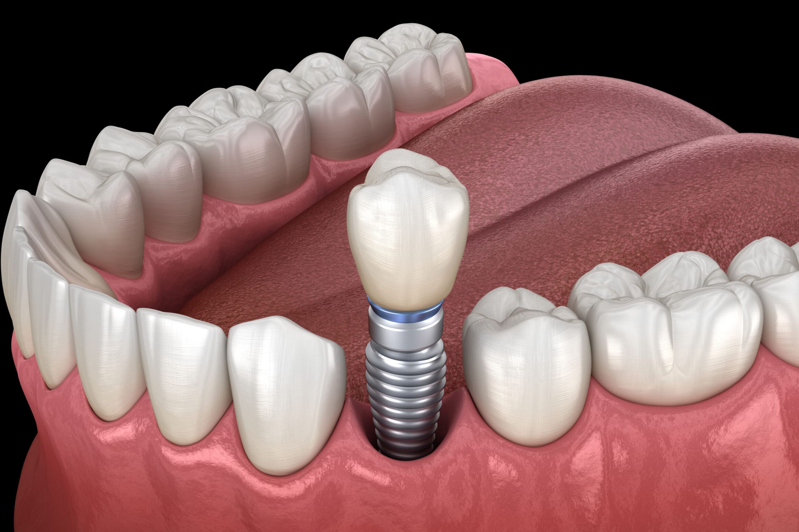 Showing the proper way Illustrustration of the the dental implant procedure that needs to be done
