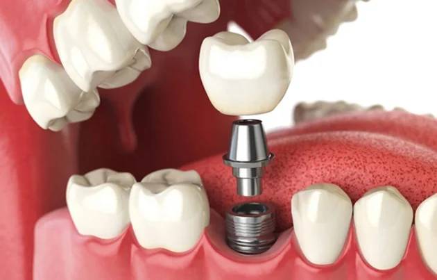 3D illustration of a dental implant being placed in the jaw, showcasing the titanium post and surrounding natural teeth, related to single tooth implant restoration at Warwick Dental.