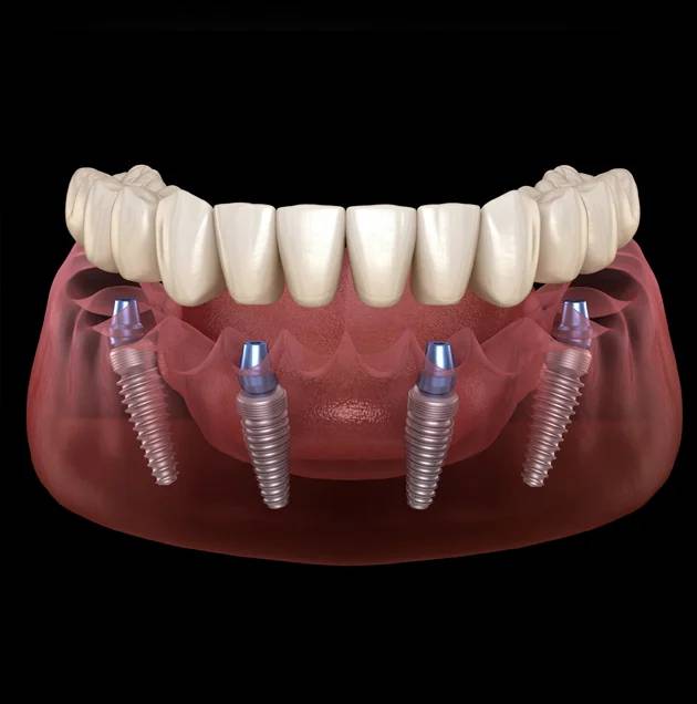 3D illustration of dental implants with artificial tooth roots, showcasing All-on-4 dental implant system for restoring smiles in Oklahoma City.