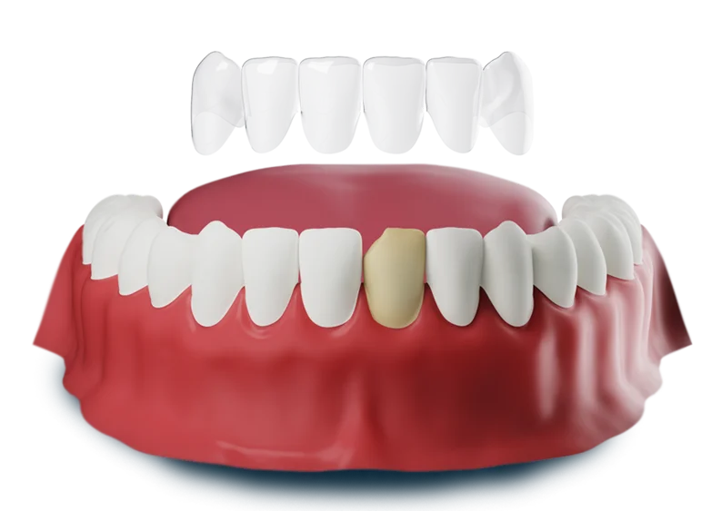 3D image Porcelain Veneers structure at Oklahoma Implant and Sedation Dentistry