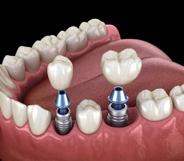 3D image of the procedure of dental implants placement at Oklahoma Implant and Sedation Dentistry