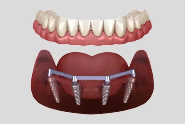 3D model of All-on-4 dental implants showing upper zirconia teeth and lower implant-supported bridge with screws, illustrating advanced dental restoration techniques.