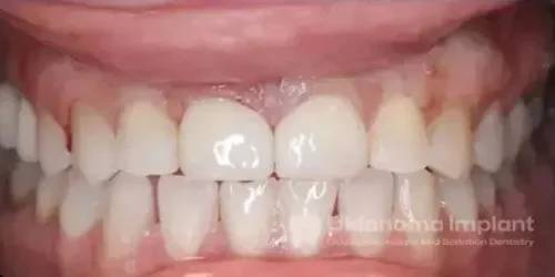 Close-up of a healthy smile showcasing dental implants and natural teeth, highlighting the results of advanced implant solutions at Warwick Dental in Oklahoma City.