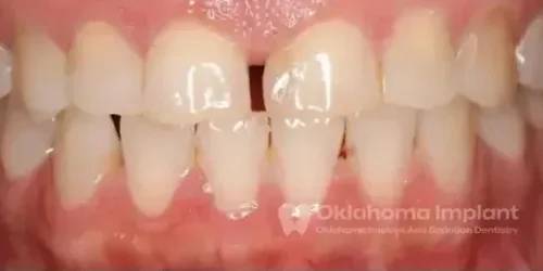Close-up of a healthy smile showcasing dental implants, emphasizing tooth restoration and aesthetic improvement at Oklahoma Implant and Sedation Dentistry.