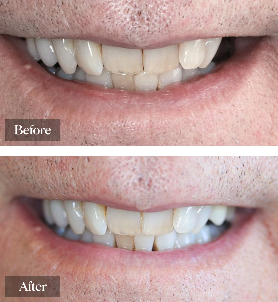 Before and After having Dental Cleaning at Warwick Dental