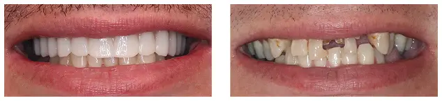 Before and After images of dental implant procedure at Warwick Dental Oklahoma City, OK