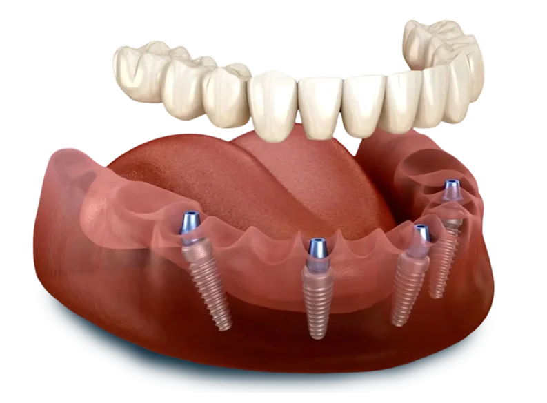 All-on-4 dental implant structure with permanent zirconia teeth, showcasing four titanium implants supporting a full arch of natural-looking teeth.