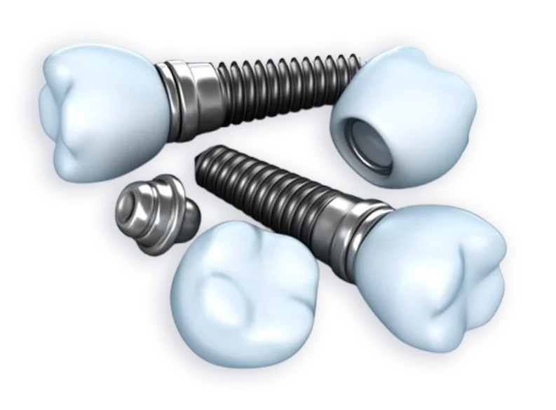 Dental implants with titanium screws and natural-looking crowns, representing tooth replacement solutions at Oklahoma Implant Clinic.