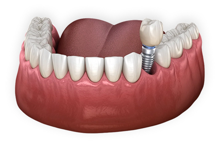 Illustration of dental implant in a mouth model, showcasing failed dental implant treatment options and restoration solutions at Warwick Dental.