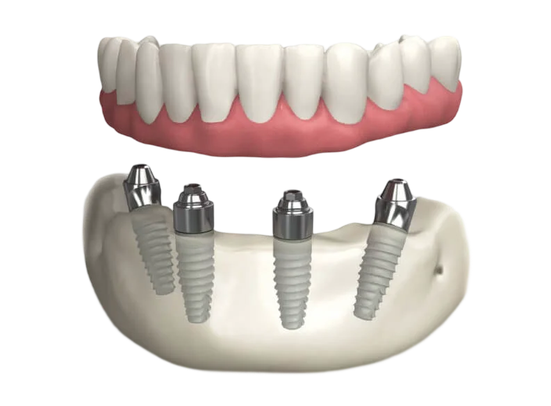 3D illustration of dental implants with a complete arch of artificial teeth, showcasing the 'New Teeth in One Day' procedure offered by Warwick Dental in Oklahoma City.