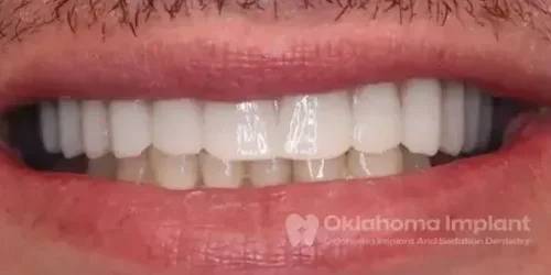 Teeth after dental implant procedure at Oklahoma City