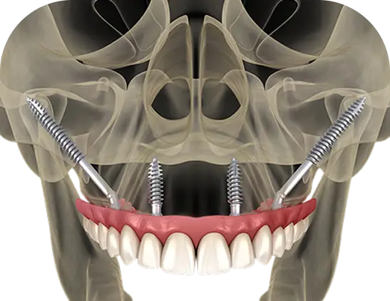 3D illustration of zygomatic dental implants in the upper jaw, showcasing screws anchored in the zygomatic bone, highlighting the dental procedure for patients with insufficient jawbone.