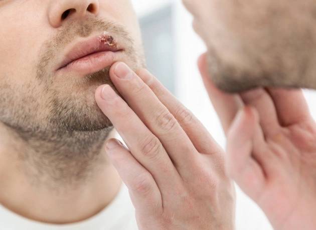 Man self-analyzing in the mirror with a cold sore on his lips in Oklahoma City, OK.