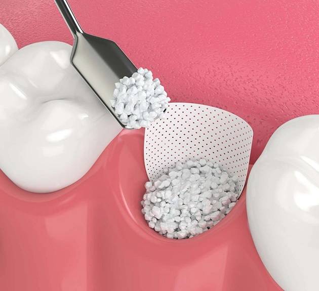 Illustration of the procedure of dental bone grafting at Warwick Dental in Oklahoma City.