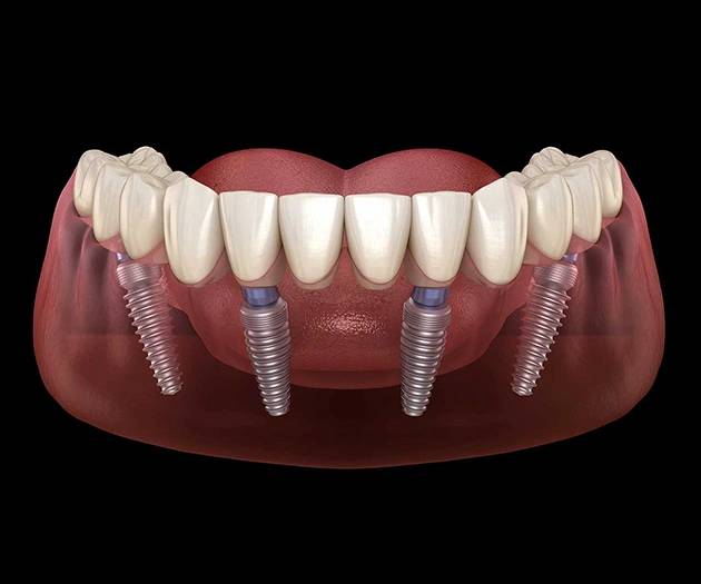 3d Illustration of full mouth dental implants treatment at Warwick Dental